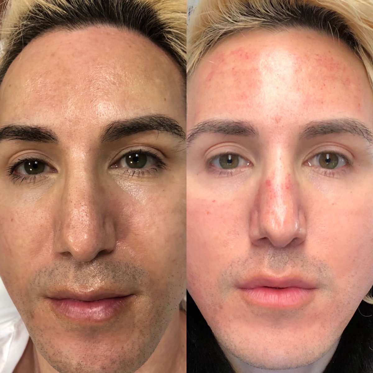 RickyRebelRocks's tweet photo. @LoudounMedical is under attack by #cancelculture TDS trolls saying she is anti LGBT but she could not be futher from that! She is my skin care guru who knows how to turn back the clock! Photo, Day 1 results. Please leave a 5 star review https://t.co/UaLQQHtZeA https://t.co/AxvzM08pvk