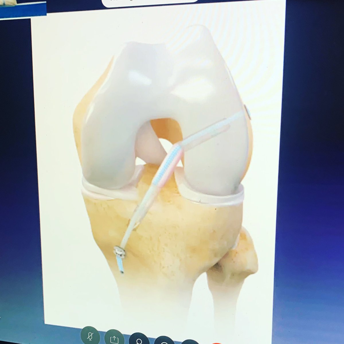 exec_physio's tweet photo. Great webinar on the evolution of ACL reconstruction! Thanks Mr Rahul Patel and HCA healthcare!
#aclrepair #graftchoice #internalbracing #hamstringgraft #aclrehab #kneepain #kneephysio https://t.co/pPQlf6axaw