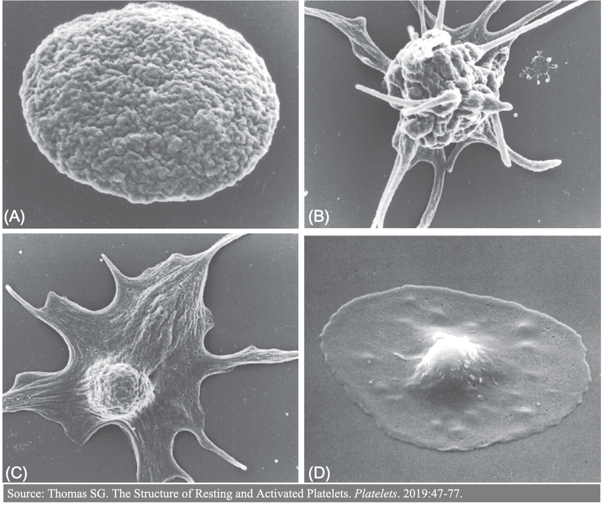 1/16Why does uremia cause platelet dysfunction (i.e., what are "uremic platelets")?The association between kidney disease and bleeding has been observed for centuries and remains incompletely understood.Let's have a look at platelets, bleeding, and a few of those humours.