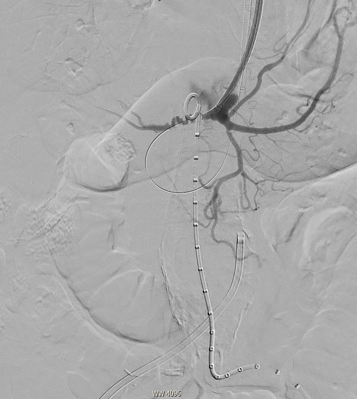 JayMathewsMD's tweet photo. 6.5 cm TAA with occluded celiac and diseased SMA ostium s/p retrograde fix of celiac via Cmd 18 ST and Spex 18 LP to cross. Then body floss from both arms for VBX snorkels over the same wire. Gore CTAG from below. Thanks to VS bro Howard Hermans MD for the help! 4 hours. https://t.co/3htHrfRnUx