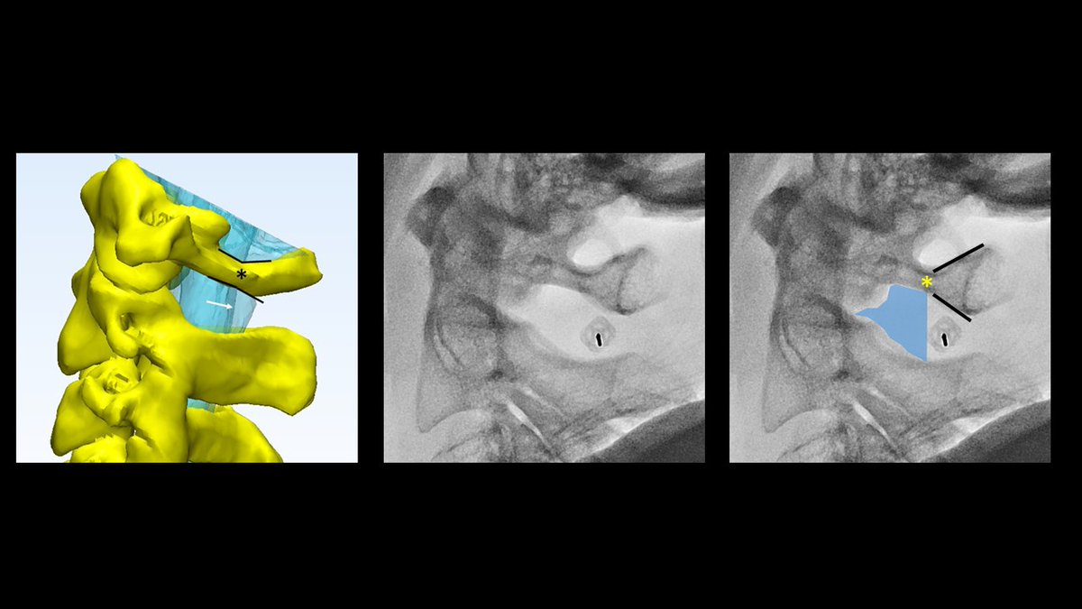 TroyHutchins3's tweet photo. First day new spine fellow C1/2 puncture bullseye. C1/2 posterior arch flare point bony landmark helped him with the target and helped me not touch the needle. More info at https://t.co/Bs6VfNGVCX (shameless self promotion). #UofUSpine #FOAMRad #spine https://t.co/qhqmD222FF