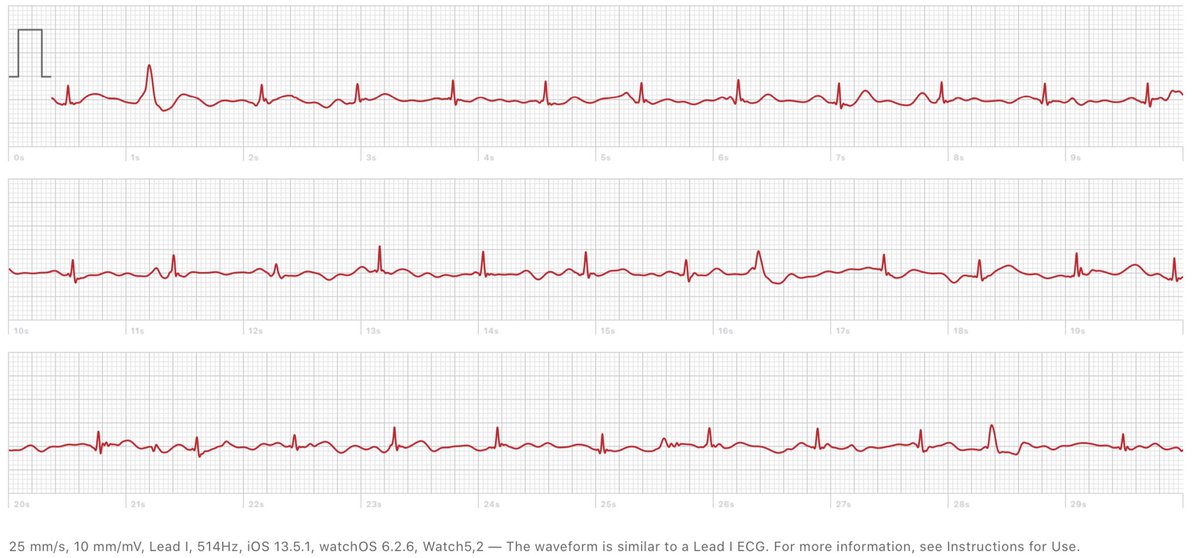 Pvcs Apple Ecg Availability Apple Watch Detect Pvc 2025