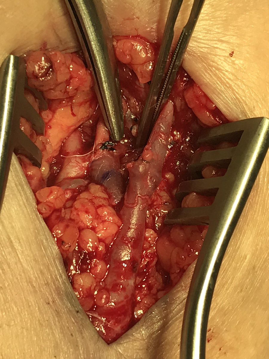 Vernon_HorstMD's tweet photo. HD access day (hand toward top in each picture): Cimino with pSLOT; snuffbox RADAR; and Jennings fistula off the common and recurrent radial arteries. #maximalfelloweducation #lifeaccessplan @OUVascular @prn19 https://t.co/ZKYrdHvReM