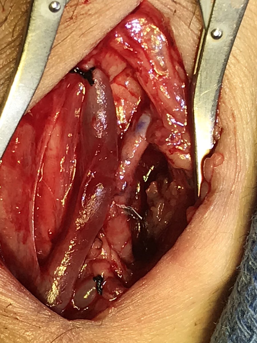 Vernon_HorstMD's tweet photo. HD access day (hand toward top in each picture): Cimino with pSLOT; snuffbox RADAR; and Jennings fistula off the common and recurrent radial arteries. #maximalfelloweducation #lifeaccessplan @OUVascular @prn19 https://t.co/ZKYrdHvReM