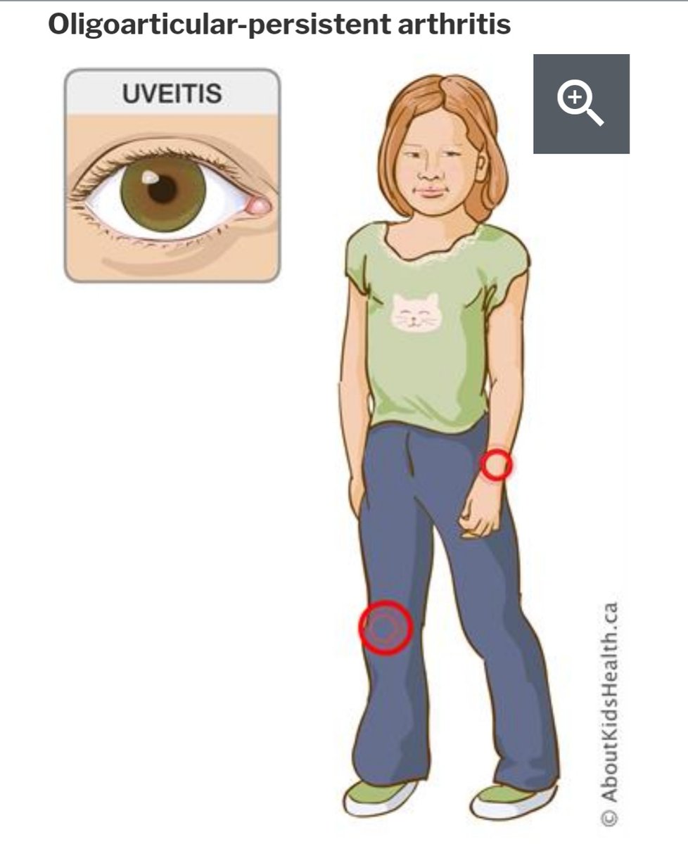 مرض التهاب مفاصل الأطفال المزمن الغير معروف السبب احادي المفصل او قليل العدد
Oligo articular juvenile idiopathic arthritis 
يتميز بالتهاب المفصل + التهاب قزحية العين المزمن
لمزيد من المعلومات يمكنكم زيارة الموقع على الرابط 
drmohammedolfat.wordpress.com/2020/07/16/%d9…