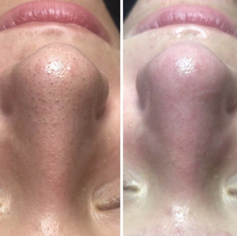 skinBeMedSpa's tweet photo. Do you have a treatment to help with blackheads and full skin? WE SURE DO. 🙌🏼💙
Consistent daily medical grade skincare, monthly dermaplane/peels, Microneedling with PRP and skinBe cocktail drips are your solution for clear glowing skin! #GLOWgetter #MondayMotivation #SkinWIN https://t.co/39BIqfvD06
