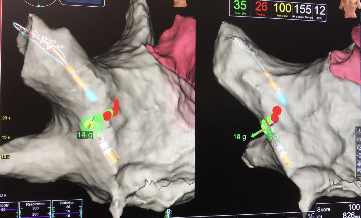 My go to catheter just got a bit better - our first use of #TactiFlex #AbbottCardio - single ring posterior wall isolation with first pass <a href="/DH_Lau/">Dennis H Lau</a> <a href="/RKutieleh/">Rayed Kutieleh</a> <a href="/Dr_VarunMalik/">Varun Malik</a> <a href="/JonathanAriya/">Jonathan Ariyaratnam</a> <a href="/Kadhimad/">Kadhim Kadhim</a> @mehrdademami