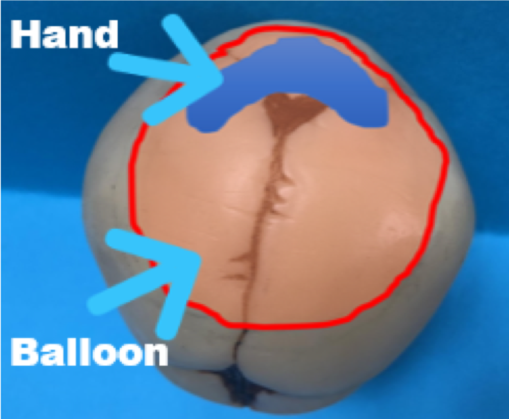 fetal_pillow's tweet photo. Use of the #FetalPillow shows a safer &amp; more gentle approach. Watch Rajiv Varma video on how the Fetal Pillow aids delivery of a deeply impacted fetal head &amp; reduce complications.
https://t.co/BL14uMK9Hm
#MakingChildbirthSafer #SaferBirths #CSectionComplications #ObGyn #Midwife https://t.co/VzaBETOiov