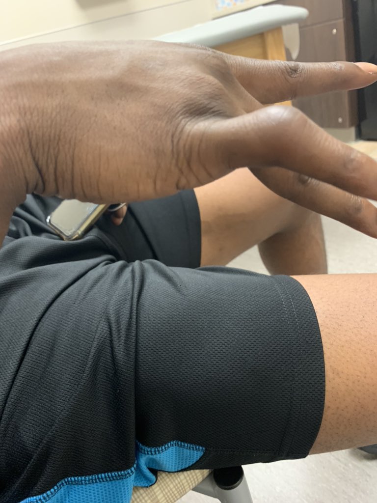 NinaAtlantis's tweet photo. Doc says he healing well. It takes time because the tendon is ripped. I said really since March? He says yes it’s a bad injury No surgery needed though and it could have been worst. His healing is on target but some deformity will remain. https://t.co/QPxk9ABUOH