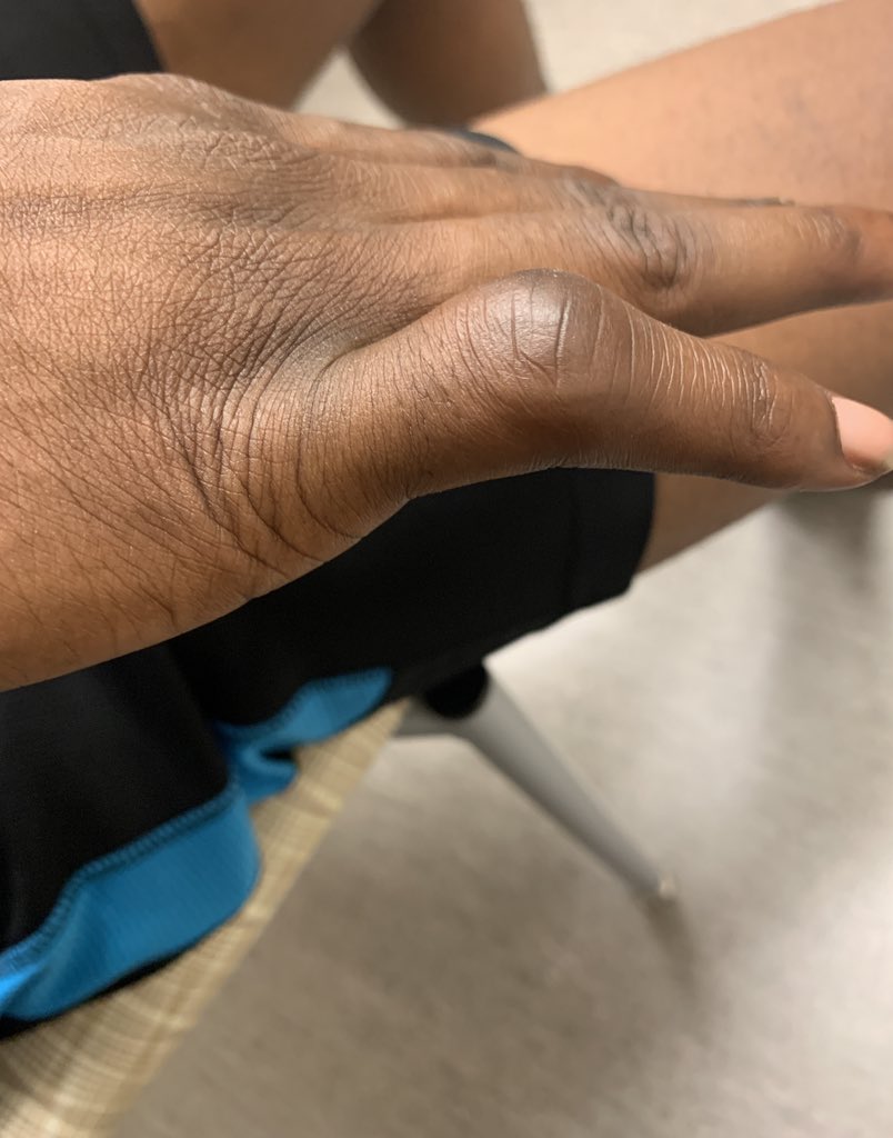 NinaAtlantis's tweet photo. Doc says he healing well. It takes time because the tendon is ripped. I said really since March? He says yes it’s a bad injury No surgery needed though and it could have been worst. His healing is on target but some deformity will remain. https://t.co/QPxk9ABUOH