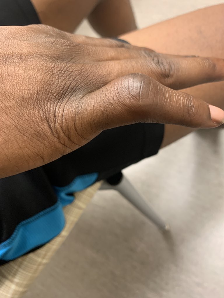 NinaAtlantis's tweet photo. Doc says he healing well. It takes time because the tendon is ripped. I said really since March? He says yes it’s a bad injury No surgery needed though and it could have been worst. His healing is on target but some deformity will remain. https://t.co/QPxk9ABUOH