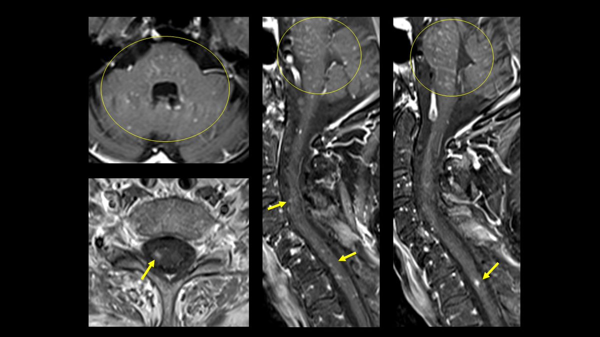 TroyHutchins3's tweet photo. Brain findings often key to unlocking spinal diagnoses as in this uncommon case of CLIPPERS with spinal cord involvement
(CLIPPERS: chronic lymphocytic inflammation with pontine perivascular enhancement responsive to steroids) #UofUSpine #FOAMRad #spine https://t.co/IA80UWVkoW