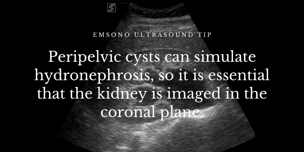 EMsonoPOCUS's tweet photo. EMsono Ultrasound Tip - Peripelvic cysts can simulate hydronephrosis, so it is essential that the kidney is imaged in the coronal plane. #EMsono #POCUS #renal #hydronephrosis https://t.co/gw2WLQJ28p https://t.co/xpH06Ovyo7
