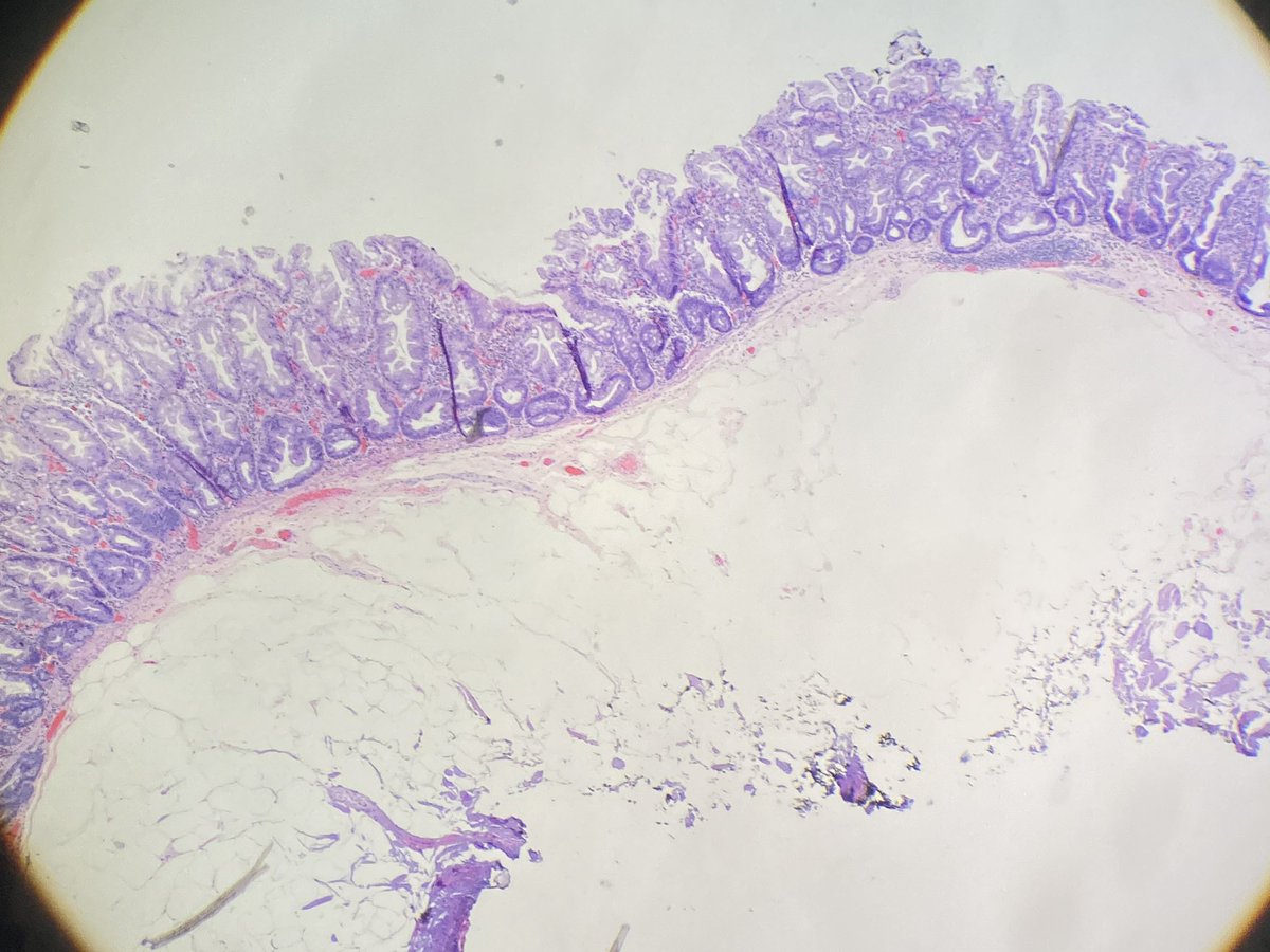 NRiddleMD's tweet photo. What a lovely Sessile Serrated Lesion #NewTerminology #GIPath https://t.co/Wo74UOgCty
