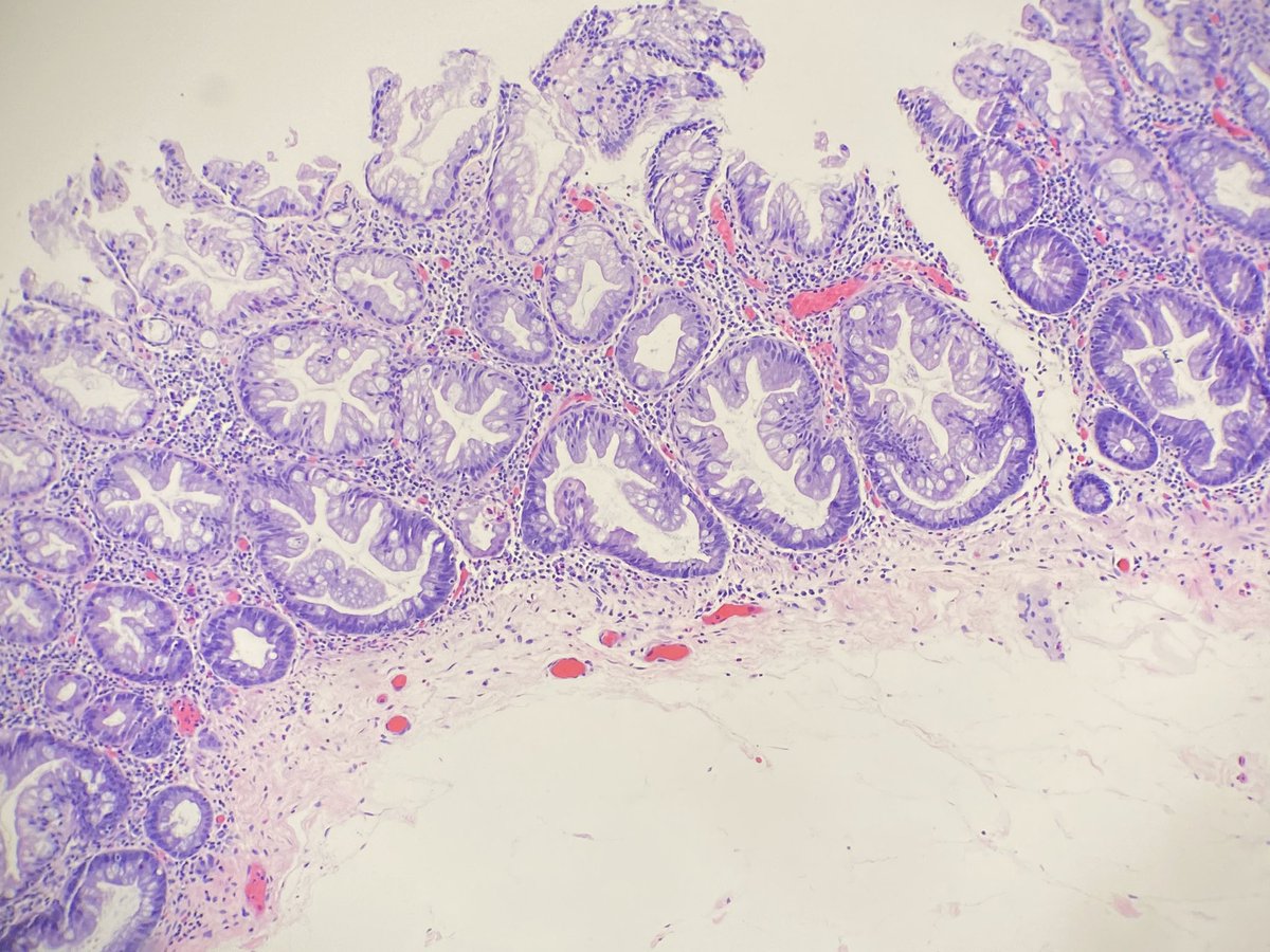 NRiddleMD's tweet photo. What a lovely Sessile Serrated Lesion #NewTerminology #GIPath https://t.co/Wo74UOgCty