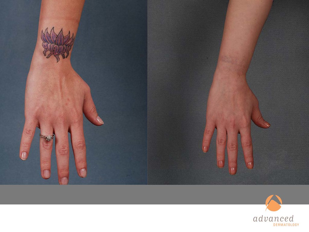 advdermatology's tweet photo. Remove your unwanted tattoo today! Call or text us at 847-459-6400 to schedule your appointment or consultation &amp; visit our website for more information: https://t.co/PxpF63c1Gs

#chicagodermatology #northshorederm #northshoredermatology #tattooremoval https://t.co/Y5P3GWWlPp