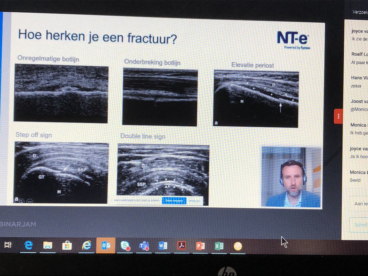 MSU en fracturen: criteria en pitfalls. Dank voor je duidelijk verhaal <a href="/Niek_NTe/">Niek Vink</a> voor de collega’s van #echonetwerk Brabant #msu #fysiotherapie <a href="/NT_echografie/">NT-e</a>