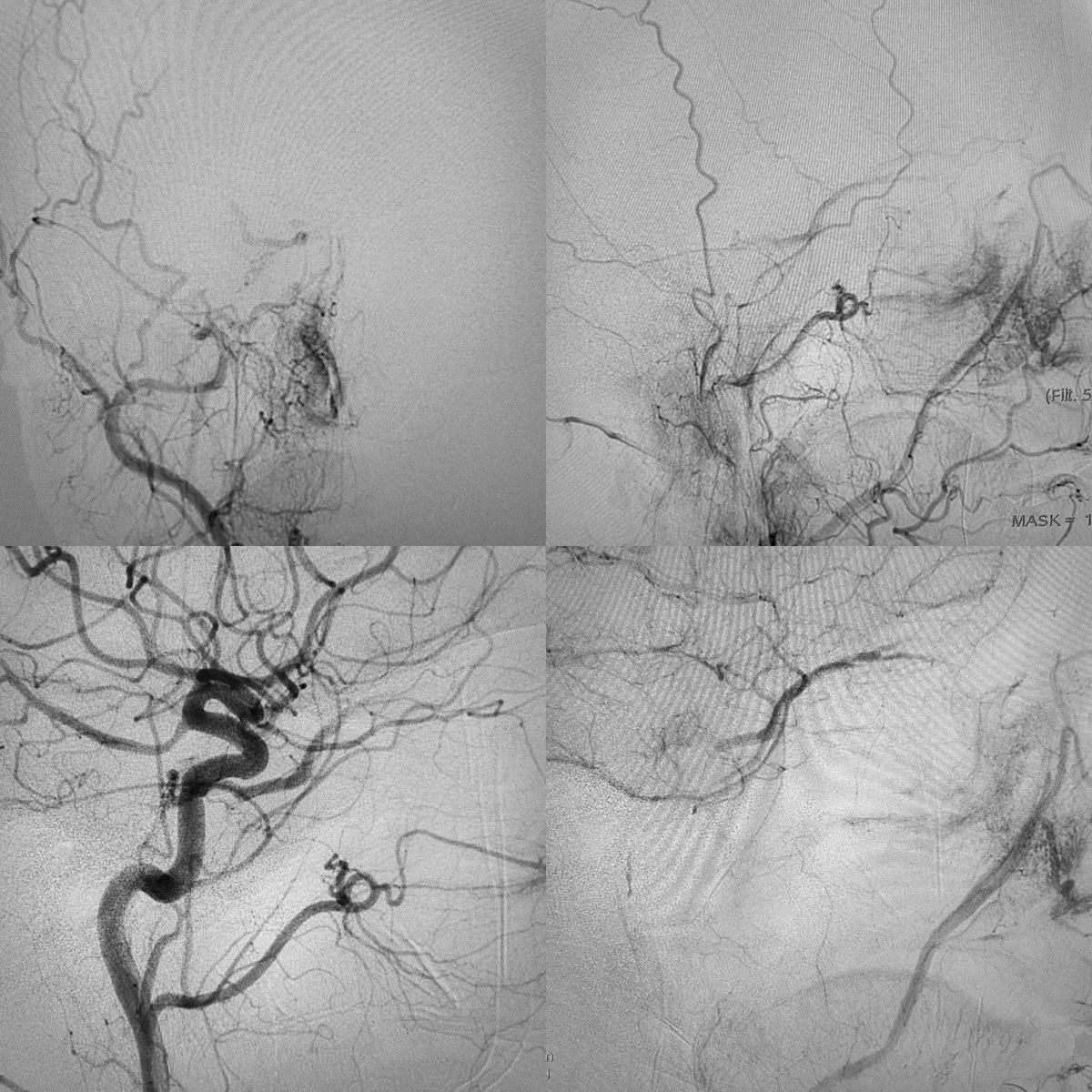 neuroabud's tweet photo. Dural AVF of the cavernous sinus with very slow flow. 
IPS and SOV thrombosed.
Embolization by venous approach through the facial vein and recanalization of the occluded superior ophthalmic vein. 
Complete exclusion of the Fistula with coils inside the cavernous sinus. https://t.co/OonJC936ht