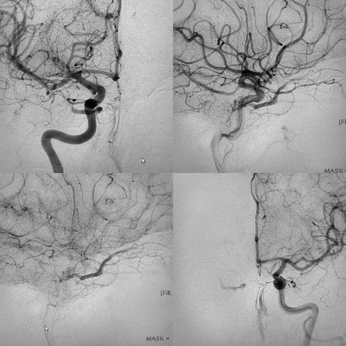 neuroabud's tweet photo. Dural AVF of the cavernous sinus with very slow flow. 
IPS and SOV thrombosed.
Embolization by venous approach through the facial vein and recanalization of the occluded superior ophthalmic vein. 
Complete exclusion of the Fistula with coils inside the cavernous sinus. https://t.co/OonJC936ht