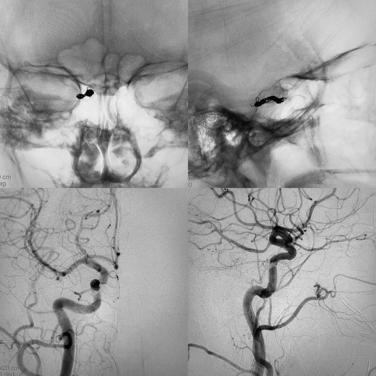 neuroabud's tweet photo. Dural AVF of the cavernous sinus with very slow flow. 
IPS and SOV thrombosed.
Embolization by venous approach through the facial vein and recanalization of the occluded superior ophthalmic vein. 
Complete exclusion of the Fistula with coils inside the cavernous sinus. https://t.co/OonJC936ht