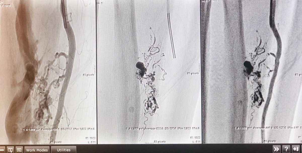 roblookstein's tweet photo. Live @MountSinaiIR chronic forearm AVF/AVM off prox radial artery before, during, and after embolization with 5:1  nbca #trufill #justglueit @SIRspecialists @SIRRFS @SIR_ECS https://t.co/XmFfd07IfK