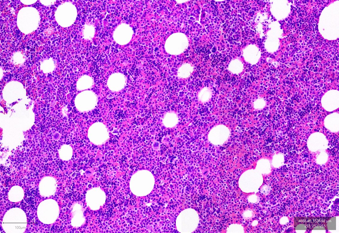 hematogones's tweet photo. I've never had a chance to make this diagnosis until today.

Dx: Adrenal myelolipoma

One more thing off of my #pathologybucketlist https://t.co/wAZa7iXg5j