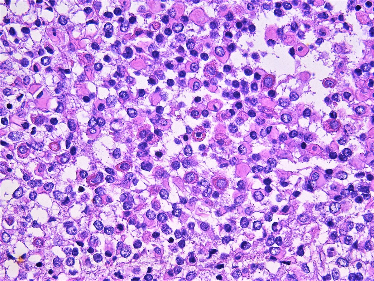 Pathology Walker@Auto Tweet Bot tweet media