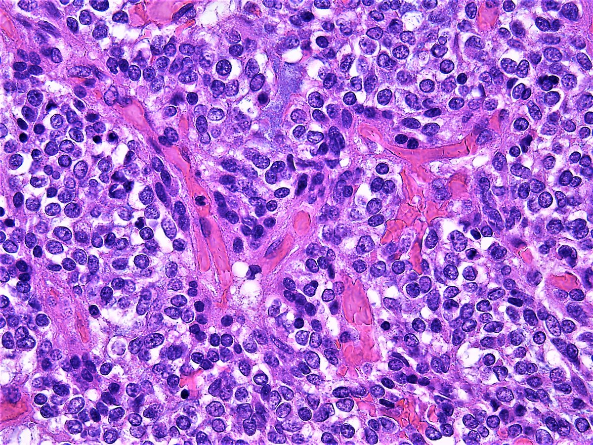 Oligodendroglioma, IDH-mutant and 1p/19q co-deleted. #Pathology #Pathologist #Neuropath
