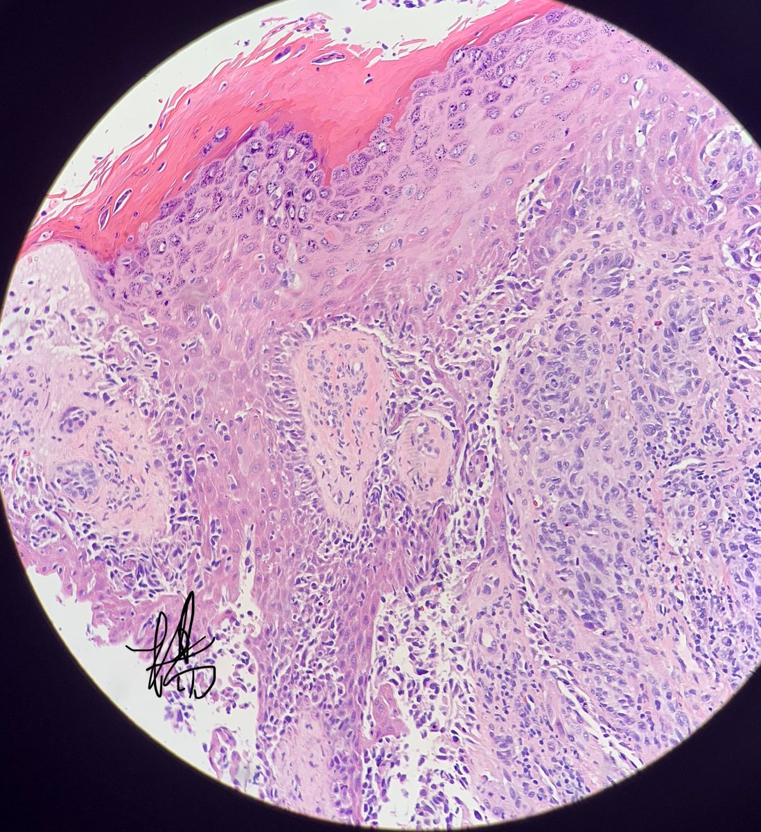 HENRYY_MD's tweet photo. this one is straight forward。right？#dermpath #amazingcase #pathology #clinpathcorrelation #CPCdp @et565 @YkselOkumu5 @lesgobeybi @SamKhader @tonitatirado @DermpatGal @vhnguyenmd @Pathology3636 https://t.co/cQcqHGzqLo