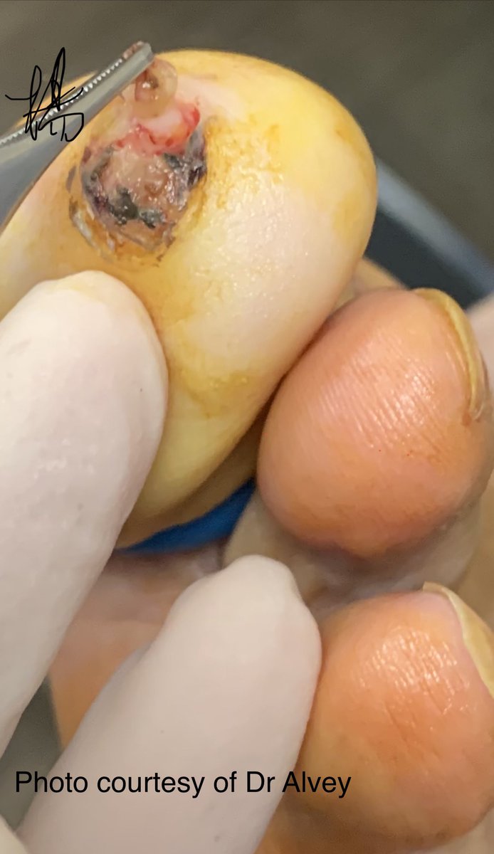 HENRYY_MD's tweet photo. this one is straight forward。right？#dermpath #amazingcase #pathology #clinpathcorrelation #CPCdp @et565 @YkselOkumu5 @lesgobeybi @SamKhader @tonitatirado @DermpatGal @vhnguyenmd @Pathology3636 https://t.co/cQcqHGzqLo