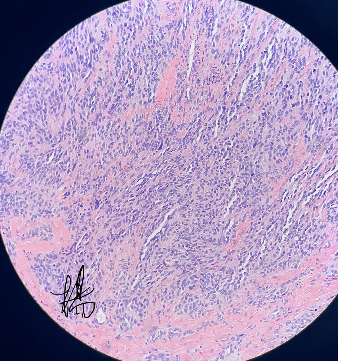 HENRYY_MD's tweet photo. this one is straight forward。right？#dermpath #amazingcase #pathology #clinpathcorrelation #CPCdp @et565 @YkselOkumu5 @lesgobeybi @SamKhader @tonitatirado @DermpatGal @vhnguyenmd @Pathology3636 https://t.co/cQcqHGzqLo