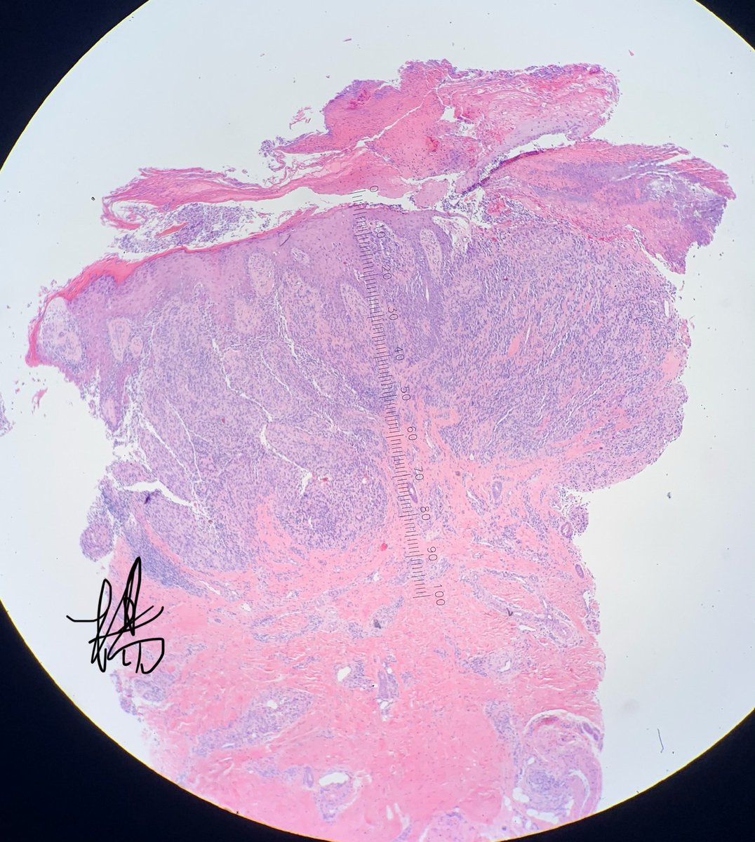 HENRYY_MD's tweet photo. this one is straight forward。right？#dermpath #amazingcase #pathology #clinpathcorrelation #CPCdp @et565 @YkselOkumu5 @lesgobeybi @SamKhader @tonitatirado @DermpatGal @vhnguyenmd @Pathology3636 https://t.co/cQcqHGzqLo