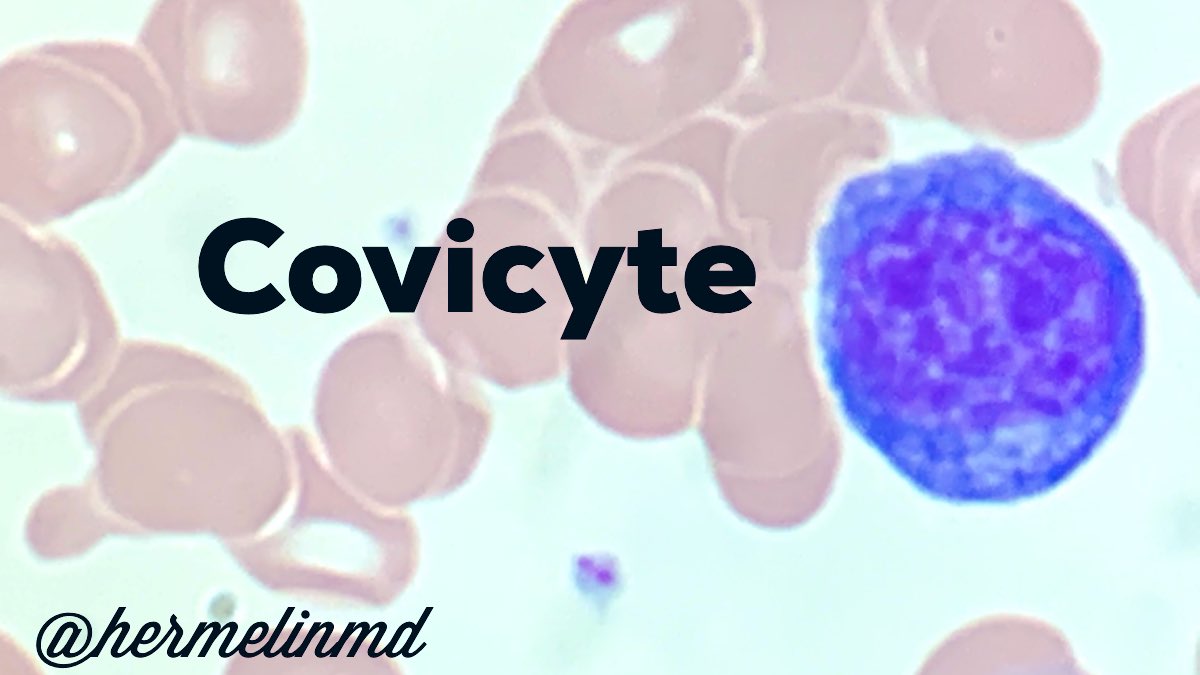 Every single peripheral smear I have viewed for an acute COVID-19 admission has #covicytes: large atypical lymphocytes w/ irregular nuclear borders and distinct deep, blue cytoplasm.  In the background of lymphopenia, they are a striking cosmic orb. Do you see them also?
