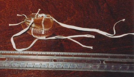 American thoracic surgeon Nina Starr Braunwald (1928-1992) led the operative team at the National Institute of Health that implanted the first successful artificial mitral valve replacement on March 11, 1960. She designed the prosthesis, known as the Braunwald-Morrow valve.