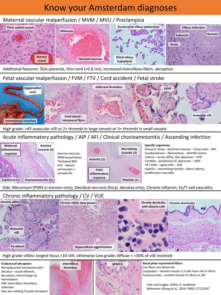 Jeff Goldstein (@jefferyagoldst1) on Twitter photo Know your Amsterdam diagnoses - quick reference / wall chart for residents or occasional placental sign-outers. #beyondchorio #placenta #pedspath <a href="/NU_Pathology/">Northwestern Pathology</a> Know your Amsterdam diagnoses - quick reference / wall chart for residents or occasional placental sign-outers. #beyondchorio #placenta #pedspath <a href="/NU_Pathology/">Northwestern Pathology</a>