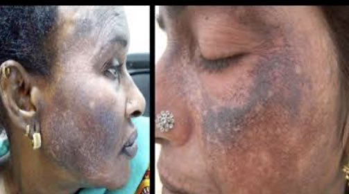 Stop misusing Steroids.Small skin rash, you will run and buy FunactA and other steroid containing cream? Stopeet!See a dermatologist for that skin rash becos the wrong medication can cause a flare or worsen the situation. You may not know, you are bleaching on a low budget.1/