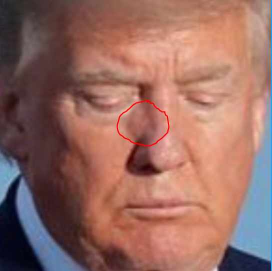  #testTRUMP4drugs |  #enforceEO12564———𝗗𝗢𝗣𝗘-𝗙𝗜𝗘𝗡𝗗 = 𝗨𝗡𝗙𝗜𝗧Discolored puffy area on both sides of his nose are scars from nostril reconstruction surgery. Morning Executive-Time is spent trying to cover them up. (Hope Hicks job?) https://twitter.com/CaslerNoel/status/1268920722715541508?s=20