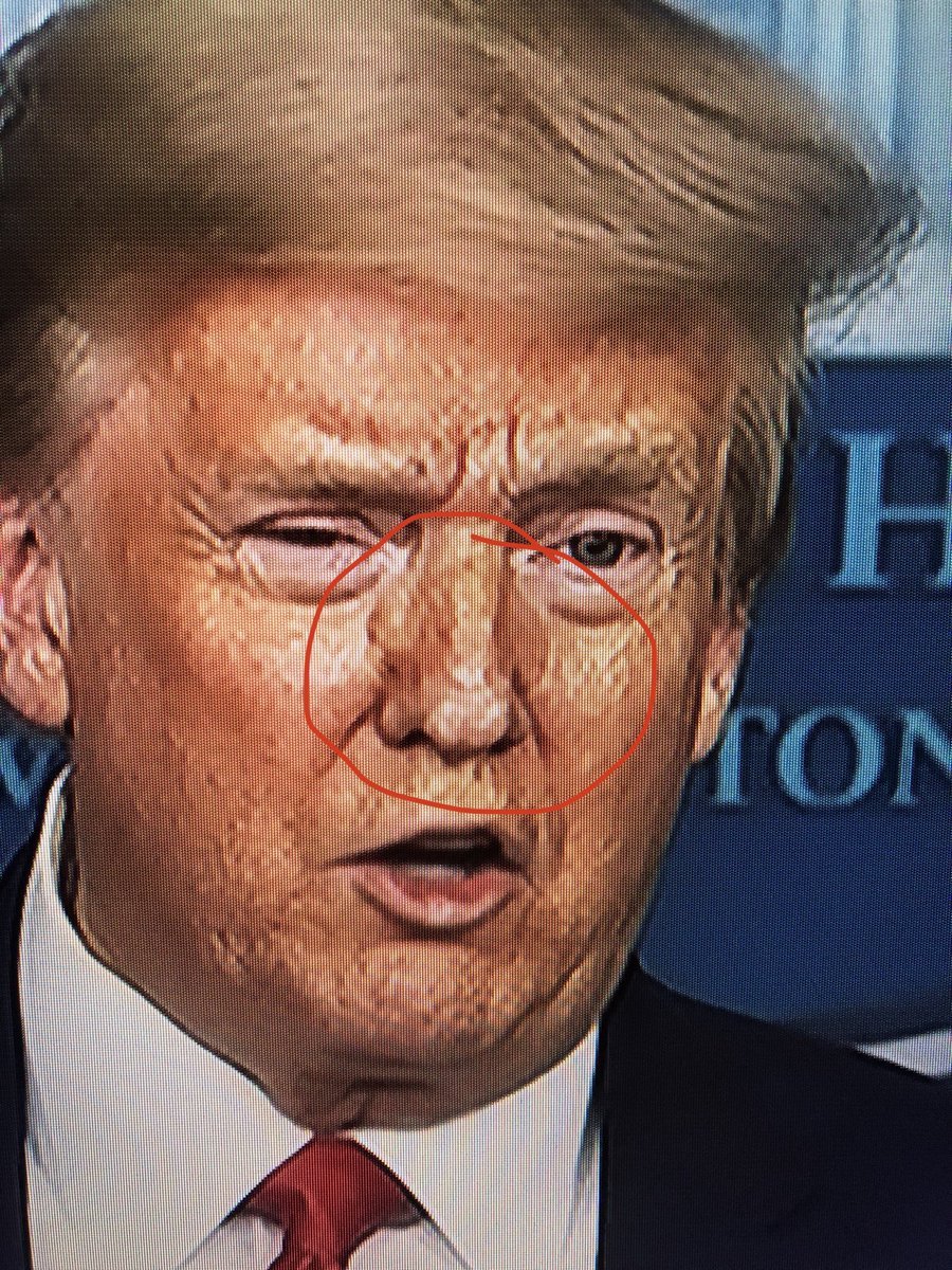  #testTRUMP4drugs |  #enforceEO12564———𝗗𝗢𝗣𝗘-𝗙𝗜𝗘𝗡𝗗 = 𝗨𝗡𝗙𝗜𝗧Discolored puffy area on both sides of his nose are scars from nostril reconstruction surgery. Morning Executive-Time is spent trying to cover them up. (Hope Hicks job?) https://twitter.com/CaslerNoel/status/1268920722715541508?s=20