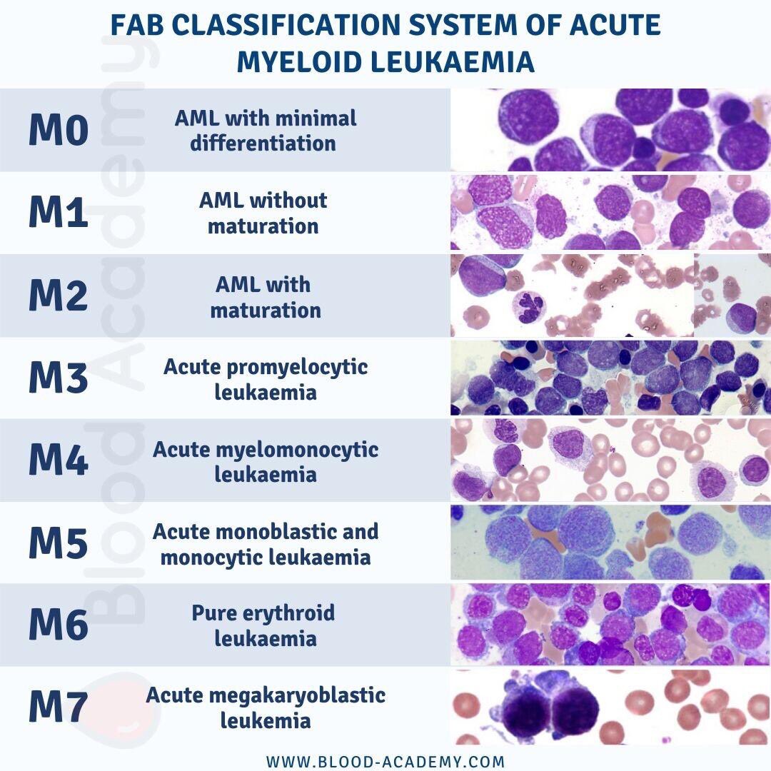 Blood Academy On Twitter 1 Fab Aml System The Initial Sub Types M1 M6 Were Initially Proposed In 1976 With Later Revisions Added M7 In 1985 And M0 In 1987 Although This