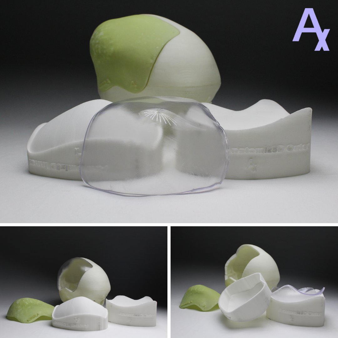Anatomiz3D's tweet photo. 13-year-old girl was suffering from a bone tumour on the right parietal bone of the skull. To diminish tumour craniotomy was essential. Two components were provided for this surgery. First, a cutting guide and second, an implant as shown in the images.

#Healthcare #3DPrinting https://t.co/BJg5M2SJuq