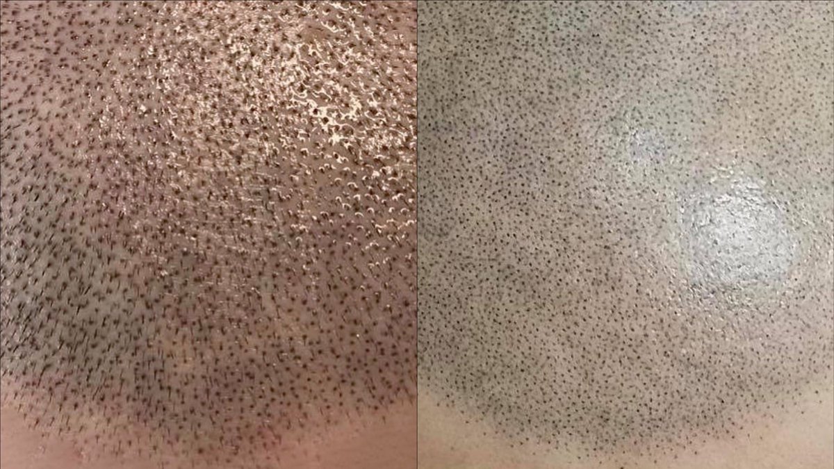 VincenzoConi's tweet image. Tricopigmentazione.
A sinistra trattamento appena effettuato, a destra il risultato finale dopo 30/40 giorni e con svariate sedute.  #Tricopigmentazione #Scalppigmentation #Tatuaggiocapelli  #Sardegna #Cagliari #Lazio #Roma #tricopigmentazionesardegnacagliari