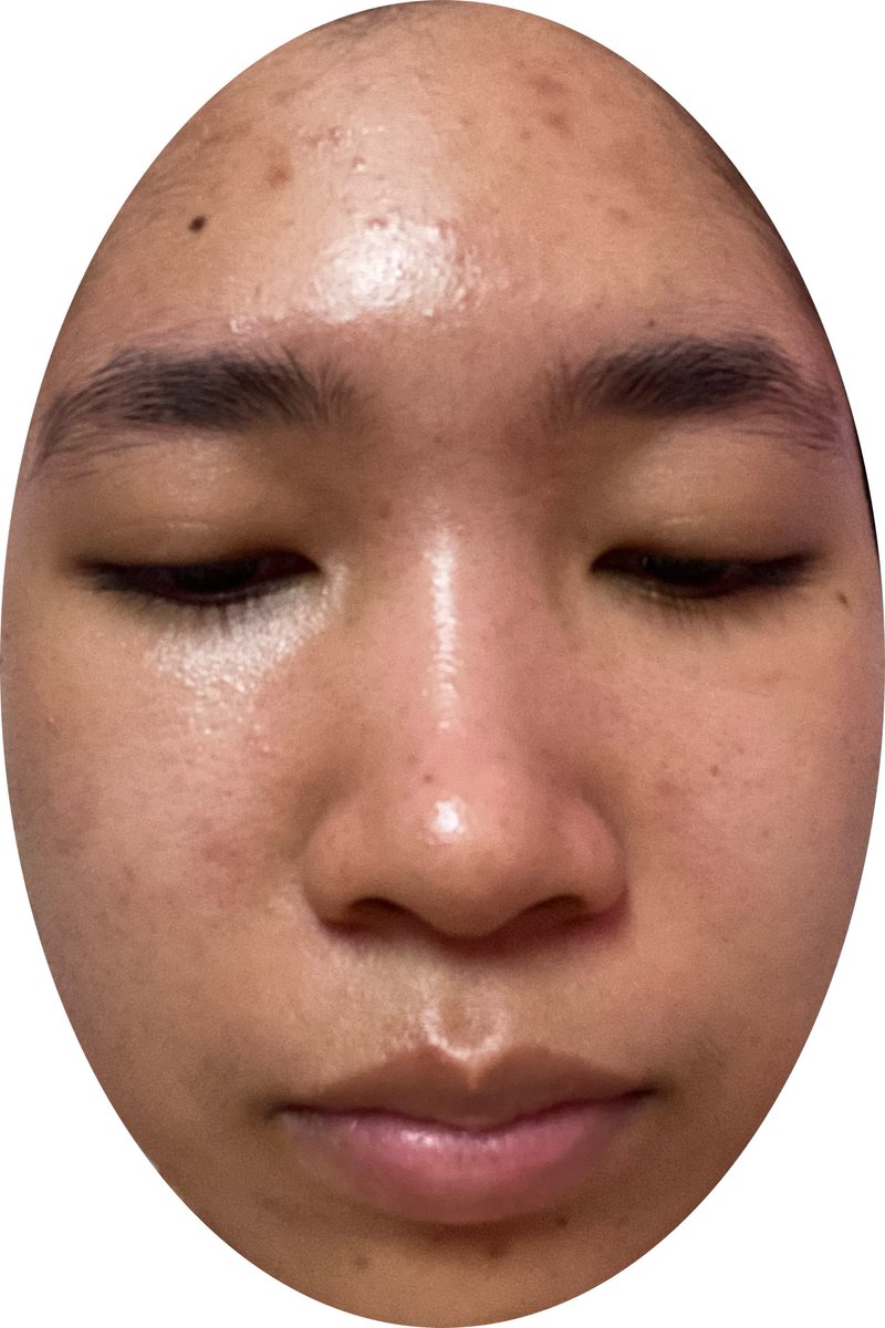 syialady's tweet photo. so happy with the progress. even tak fully clear lagi but im so happy🥰. i know the journey is freaking tough but for those yang still struggle with your skin, dont give up and keep going 💪🏻 btw sori la gambar before tu macam telur sebab crop😂

before                      after https://t.co/dIV09k5oJo