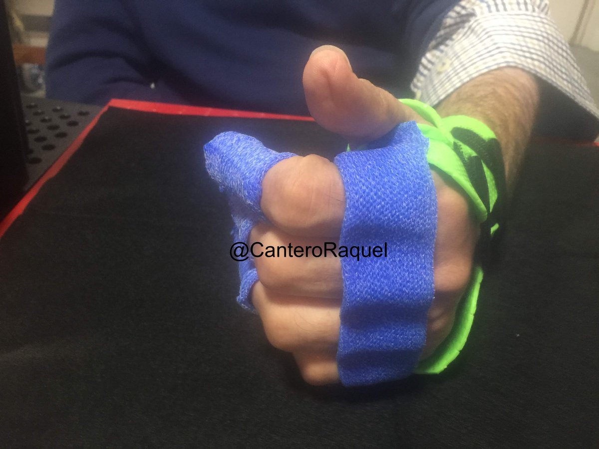 CanteroRaquel's tweet photo. Orthosis for improved PIP flexión with MCF dorsal block. #handtherapy #handorthosis https://t.co/cEj0OZn3Zu
