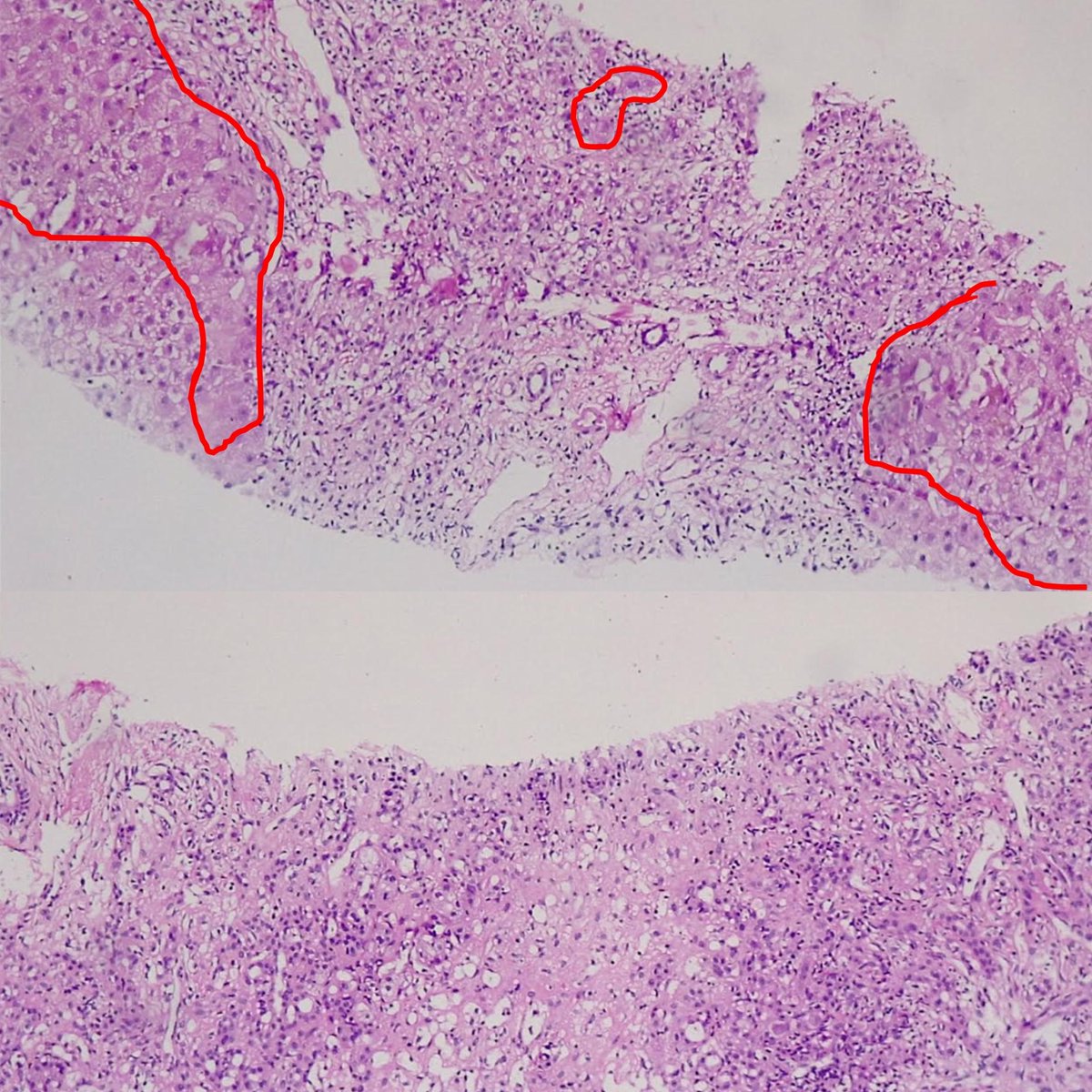 11/n #Liverbiopsy findings were out of this  #world. There is multiacinar  #necrosis – meaning areas in the liver where there is complete loss of liver  #cells. Few liver cells remain as ‘islands’ here and there (red marked). But no fatty liver disease (steatosis).  #GITwitter