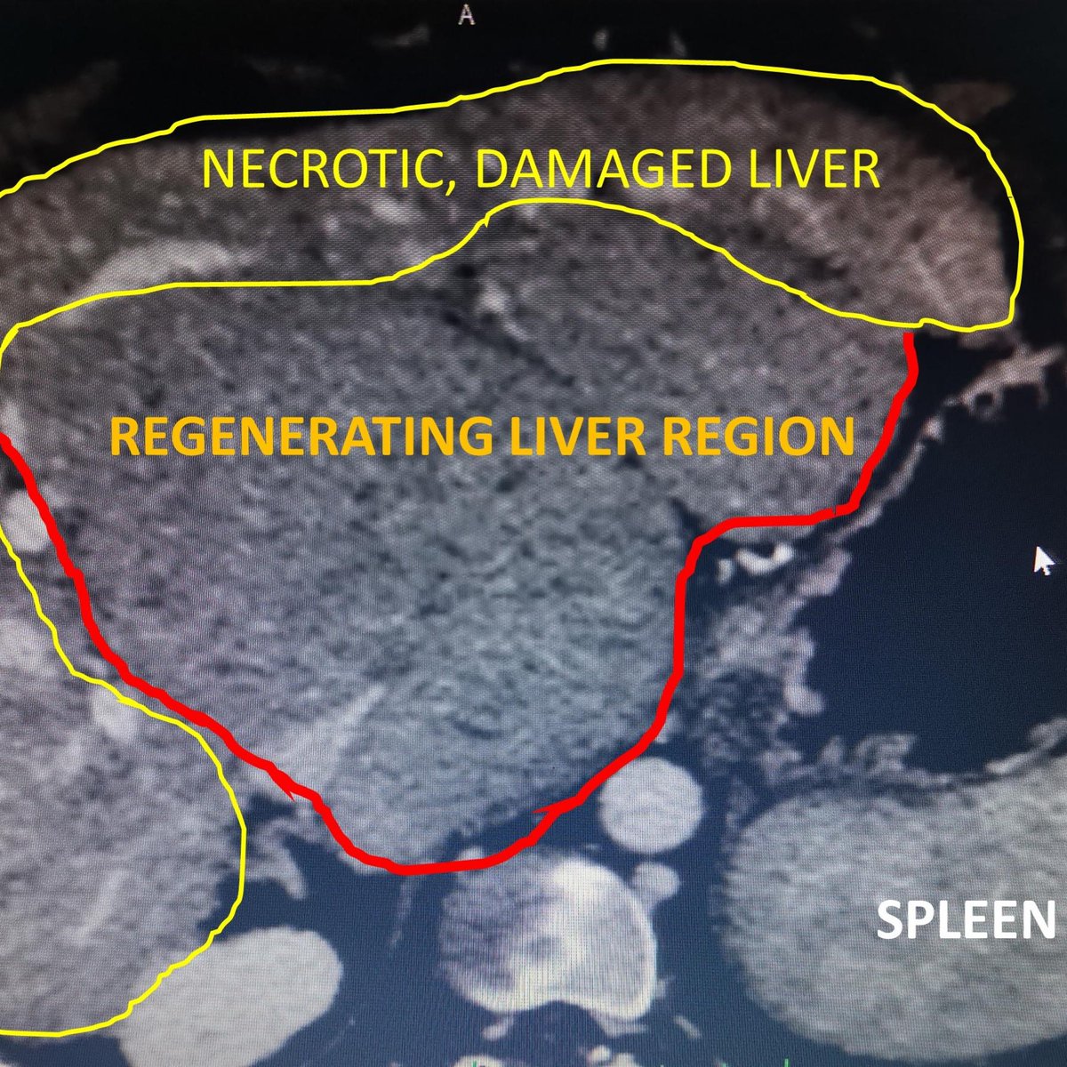 12/nCT Scan = very striking. Large area of the liver enlarged extensively, looked like a big  #tumor. But biopsy from large ‘tumor’ looking area = bunch of regenerating liver cells! Liver took care of itself during the ongoing herbal assault, preventing clinical liver failure.