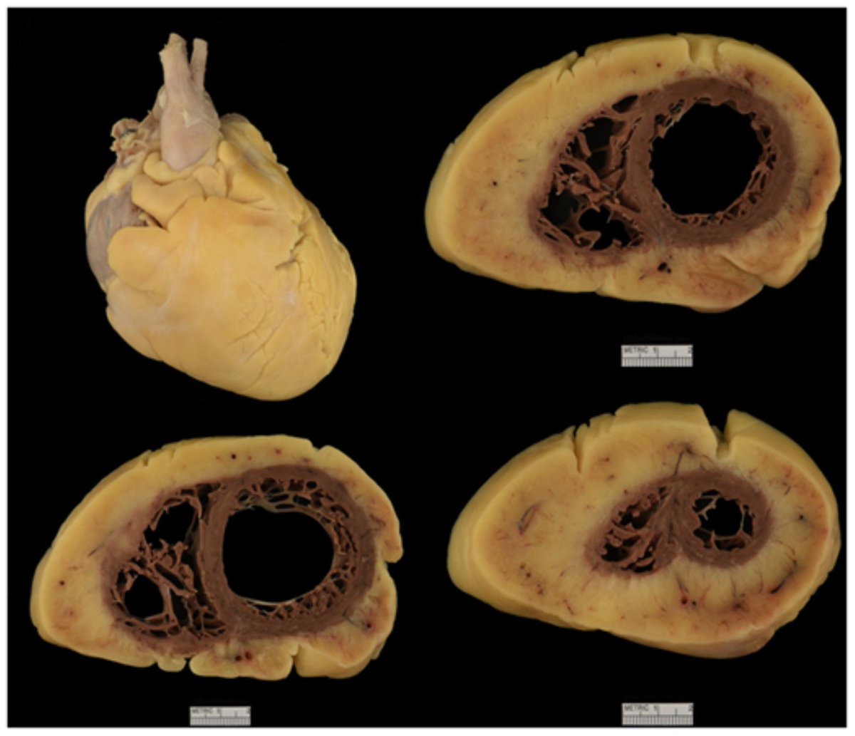 SolovevaAnzhela's tweet photo. 'The heavy heart of HFpEF'
😱 when circumferential epicardial fat deposition accounted for 46% of the total heart mass at autopsy 
https://t.co/SkaEgckUY7

@FudimMarat your paper on regional adiposity is right on time https://t.co/55uowHjGu6 https://t.co/W93uxyygP4