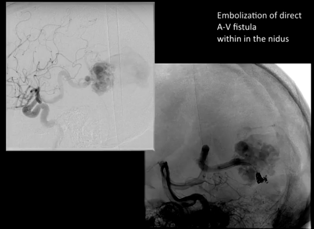 DrBaskaya's tweet photo. 72y M, known occipital #AVM with a large draining #varix for 10 years, progressively worsening visual and cognitive deficits, GTR following single stage preoperative #embolization
https://t.co/jfsxBEffkI
#nsgy #neurosurgery #microsurgery #neurosurgeon #ecase #opvid #neurocirurgia https://t.co/98RY36difW