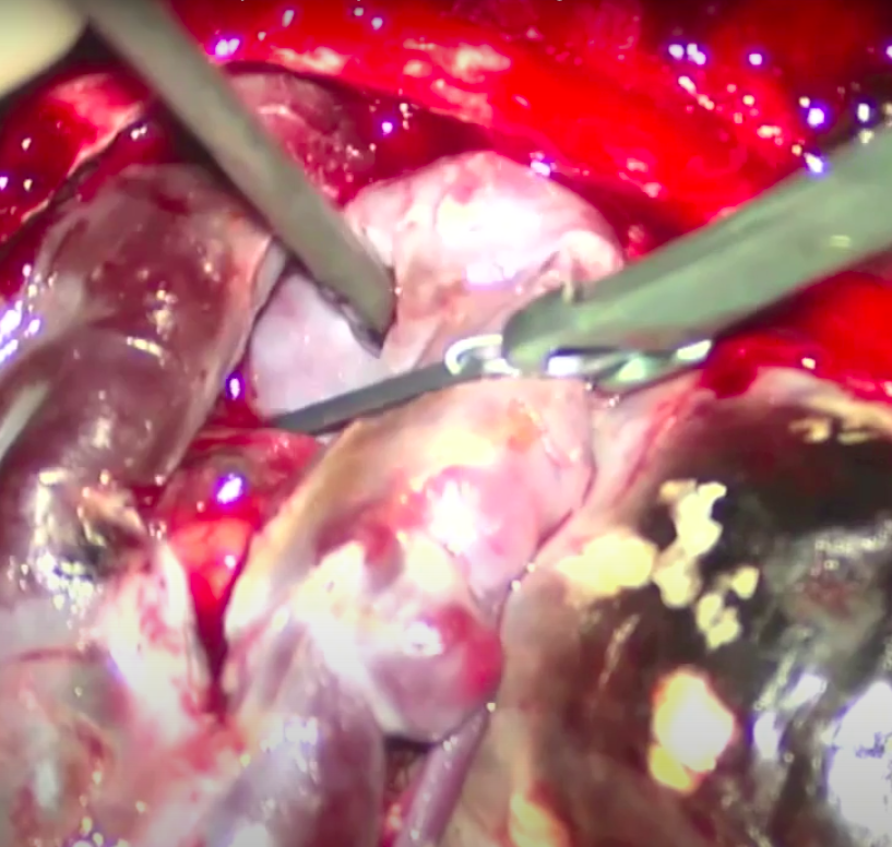 DrBaskaya's tweet photo. 72y M, known occipital #AVM with a large draining #varix for 10 years, progressively worsening visual and cognitive deficits, GTR following single stage preoperative #embolization
https://t.co/jfsxBEffkI
#nsgy #neurosurgery #microsurgery #neurosurgeon #ecase #opvid #neurocirurgia https://t.co/98RY36difW