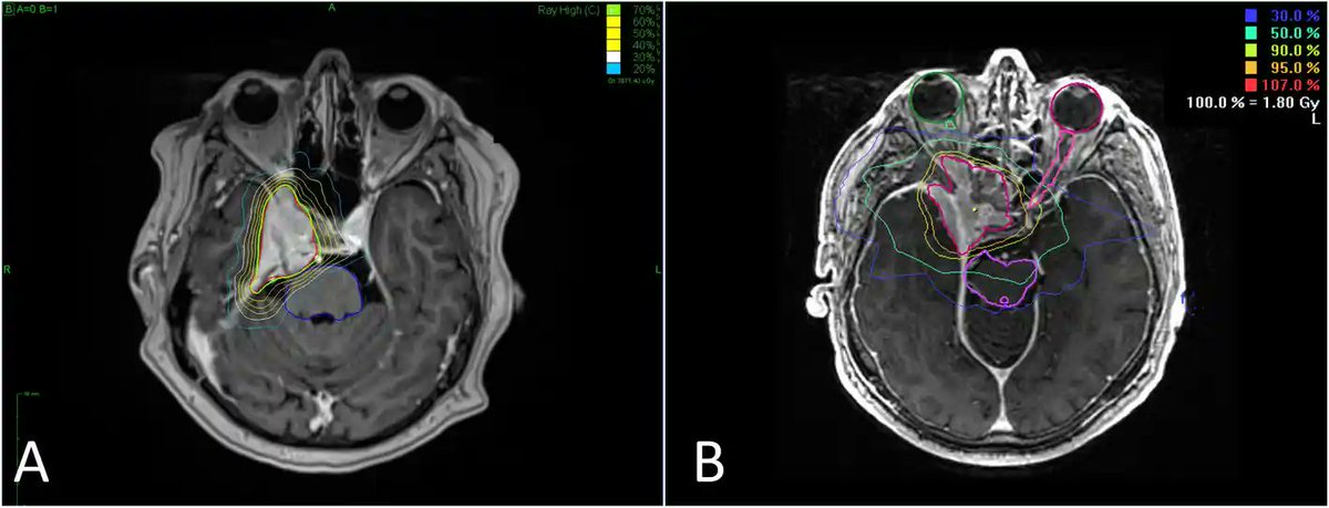 FuenteApolo's tweet photo. Normofractionated stereotactic radiotherapy versus #CyberKnife based hypofractionation in skull base meningioma: a German and Italian pooled cohort analysis
#FSRT
https://t.co/hU6XHDd7kb
Precisión submilimétrica, órganos críticos cumplen constraints. https://t.co/pLVfb9aPBO