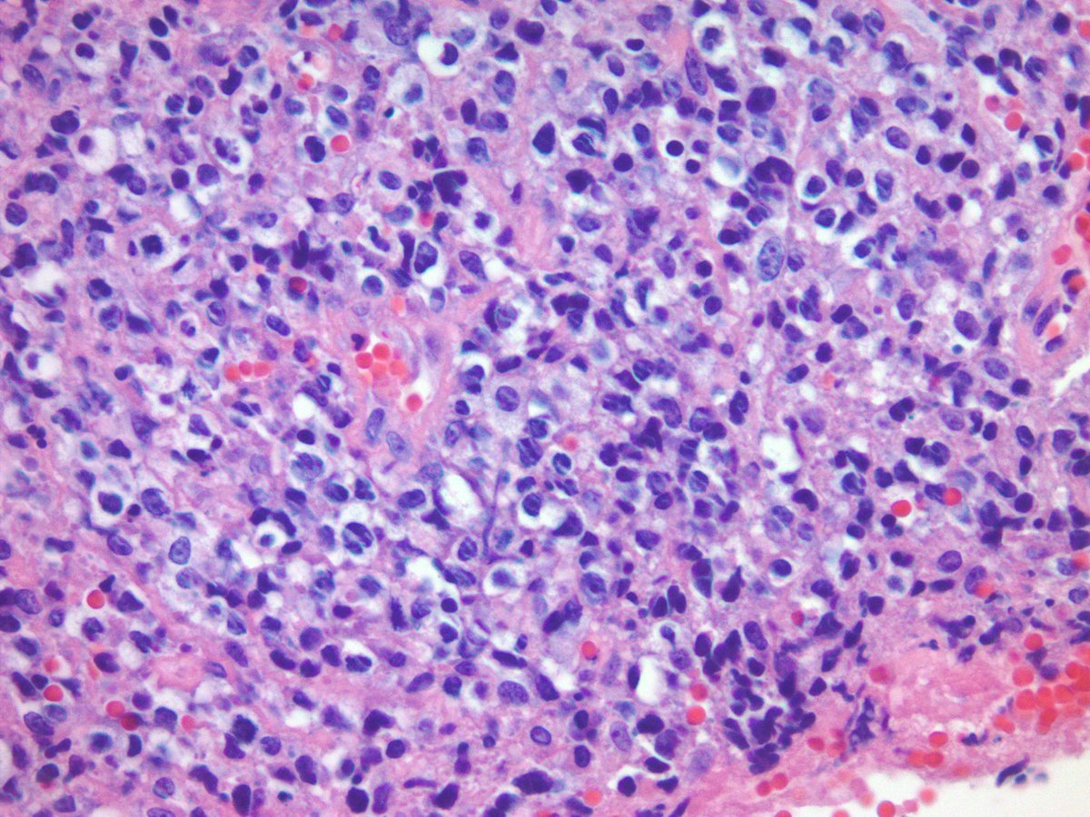 jake_bledsoe's tweet photo. What is your differential and favored diagnosis for this biopsy of a large soft tissue mass? IHC: CD20 (left), cyclin D1 (right). #hemepath #pathology https://t.co/JL174i5VZ2